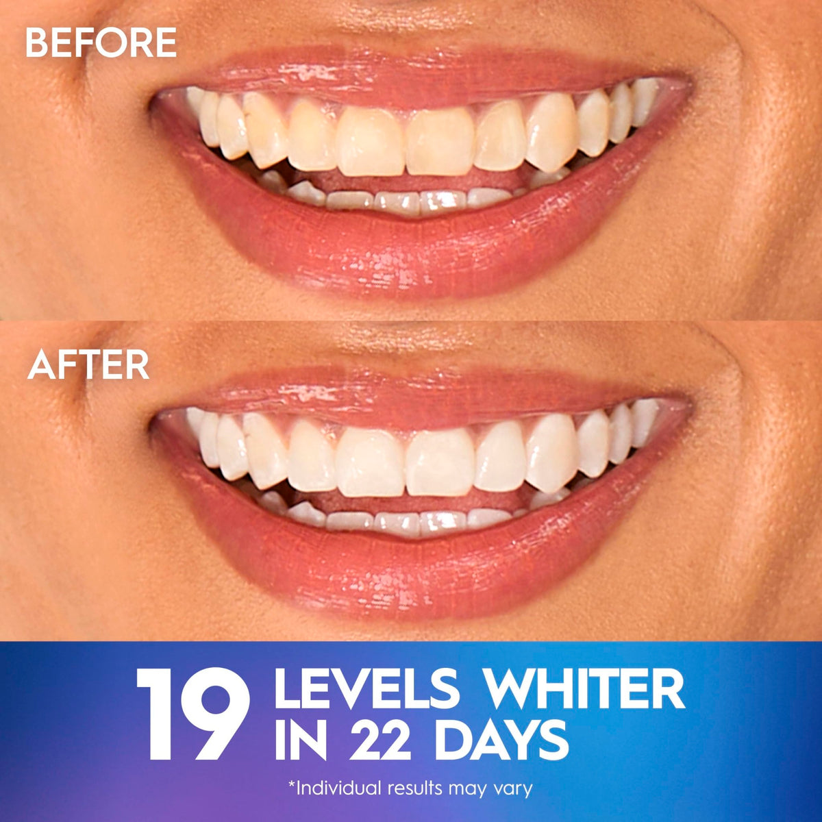 Crest Teeth Whitening Strips, Crest 3D Whitestrips Professional Effects, Enamel Safe Teeth Whitening Kit, 22 Treatments (44 Strips), Professional-Level Whitening, 19 Levels Whiter - thewildfolk Crest Teeth Whitening Strips, Crest 3D Whitestrips Professional Effects, Enamel Safe Teeth Whitening Kit, 22 Treatments (44 Strips), Professional-Level Whitening, 19 Levels Whiter
