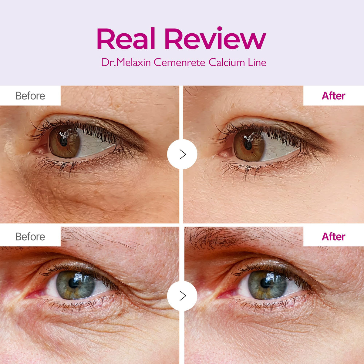 Dr.Melaxin Calcium Volume Under Eye Patches for Puffy Eyes & Dark Circles, Hydrogel Eye Mask for Wrinkles, Fine Lines & Sagging Skin, Firming Collagen Eye Patch, Korean Skin Care (60 Count) - thewildfolk Dr.Melaxin Calcium Volume Under Eye Patches for Puffy Eyes & Dark Circles, Hydrogel Eye Mask for Wrinkles, Fine Lines & Sagging Skin, Firming Collagen Eye Patch, Korean Skin Care (60 Count)